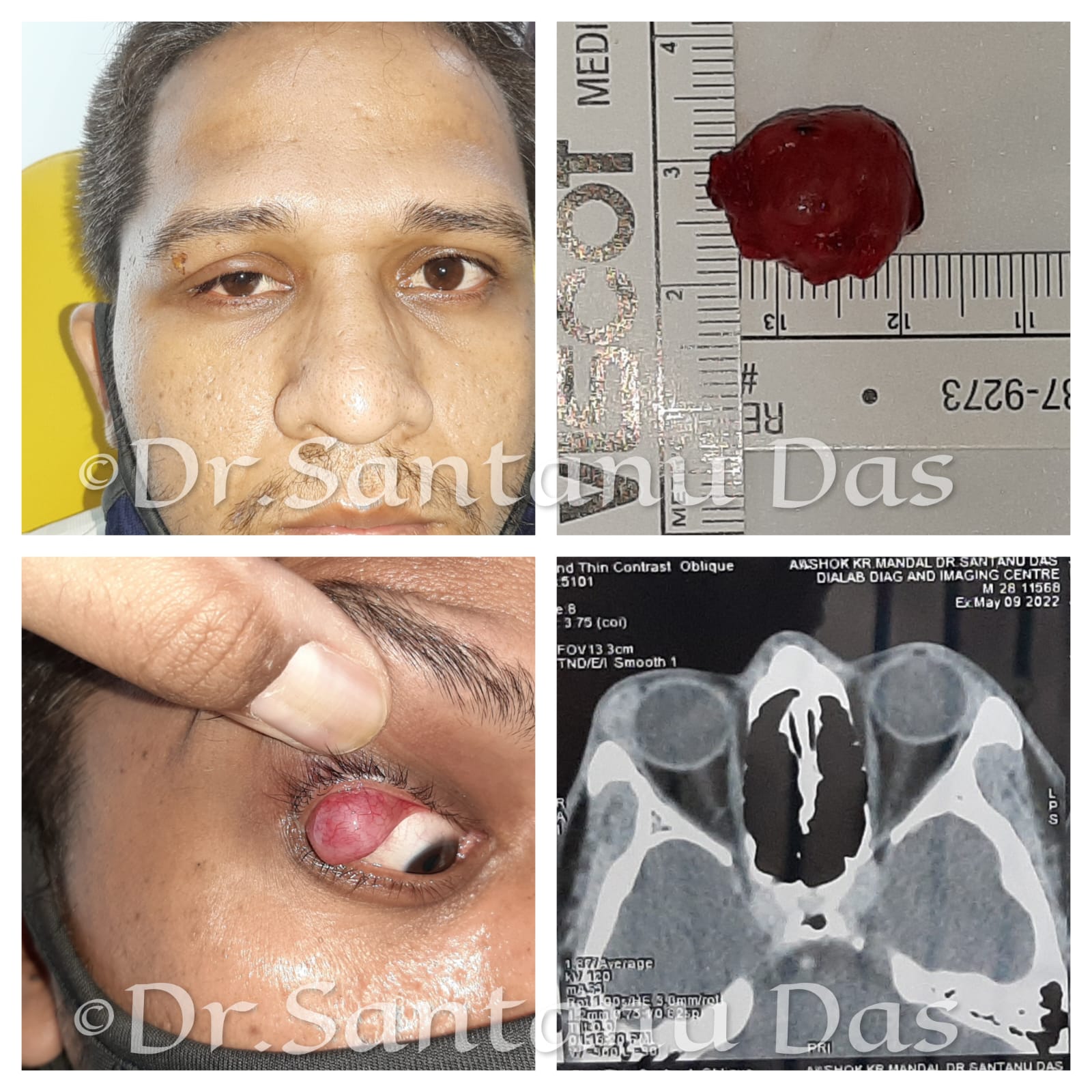 Orbital Lesion 2